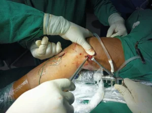 Knee replacement surgeon in nagpur