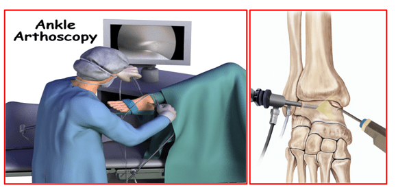 Ankle-Arthroscopy clinic in nagpur