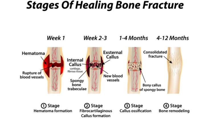 Bone fracture surgery in nagpur