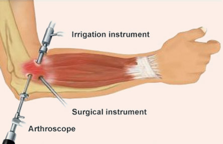 Elbow arthroscopy in nagpur
