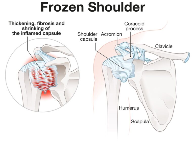 Frozen shoulder treatment in nagpur