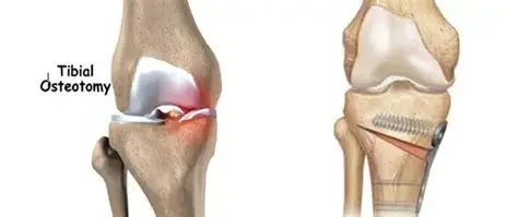 High tibial osteotomy(Hto)in nagpur