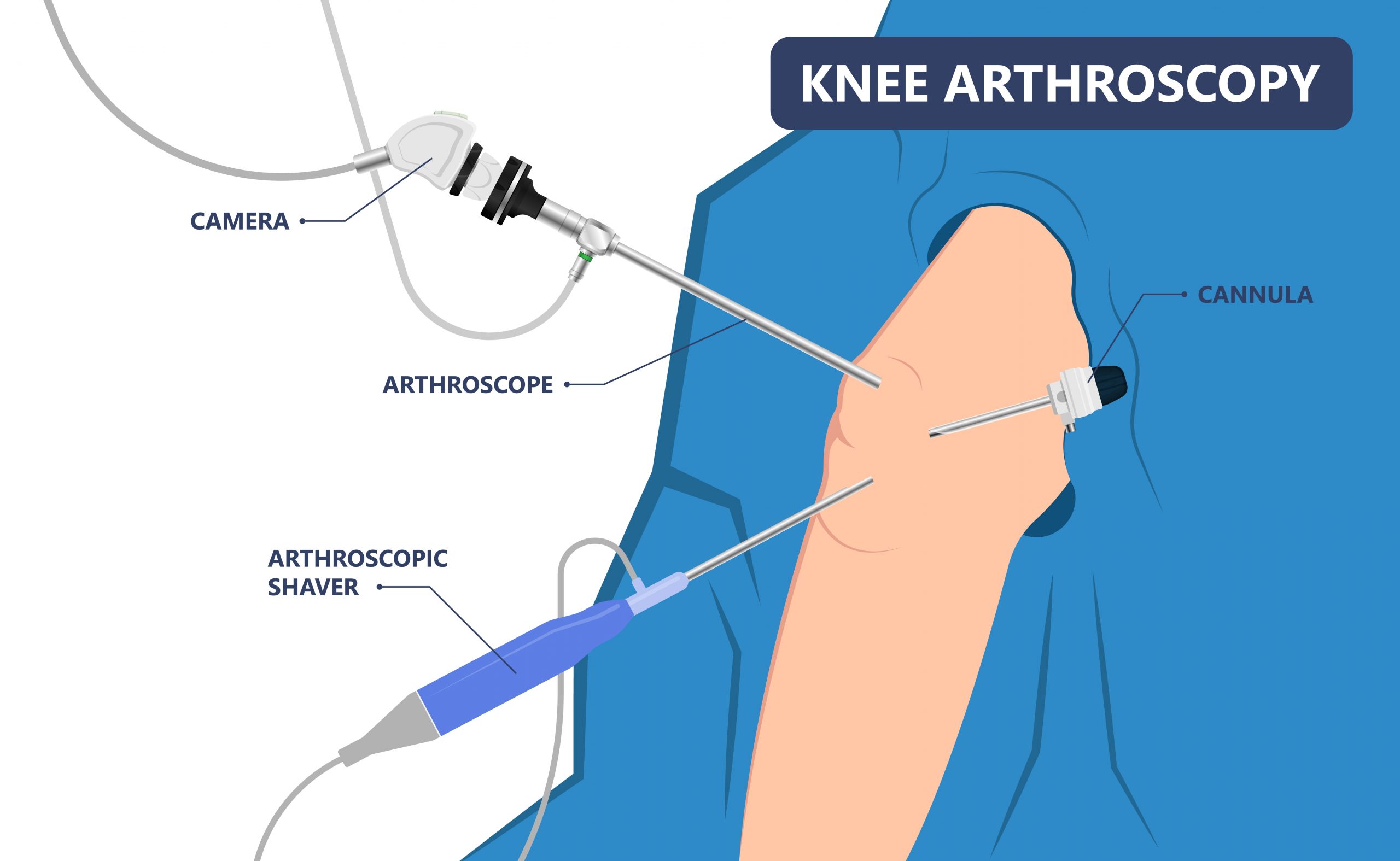 Knee arthroscopy in nagpur