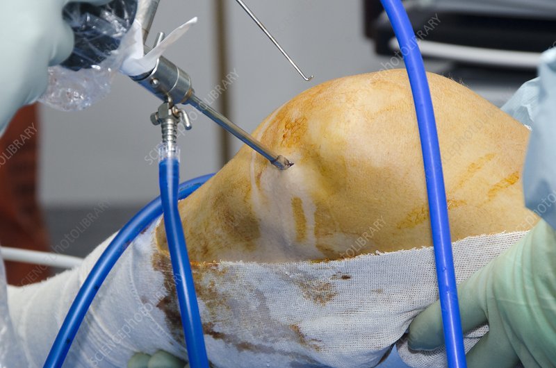 Ligament repair and reconstruction in nagpur