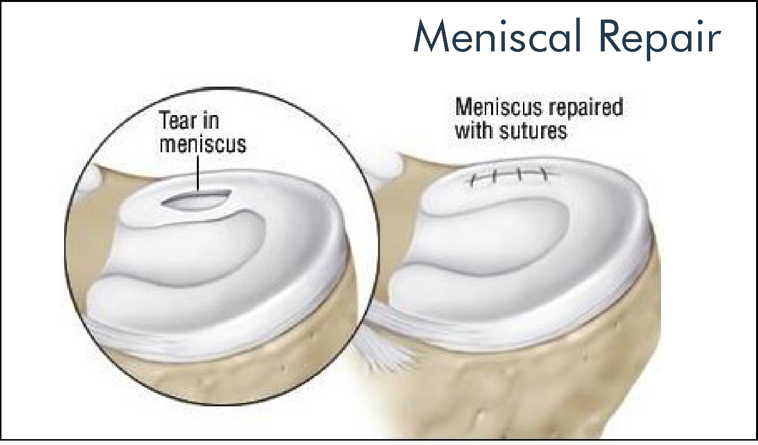 Meniscal tear repair surgery in nagpur