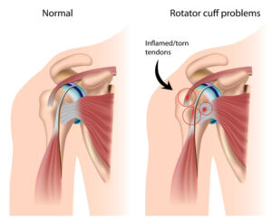 Rotator cuff surgeon in chhindwara