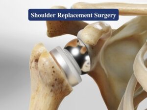 Shoulder replacement surgeon in nagpur