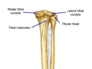 Tibial Condylar Valgus Osteotomy (TCVO)in nagpur