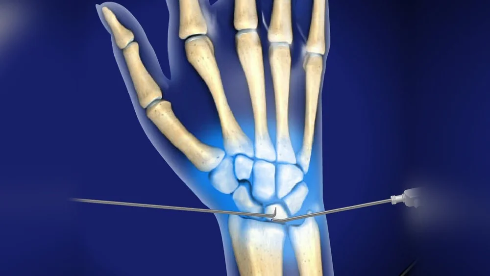 Wrist arthroscopy